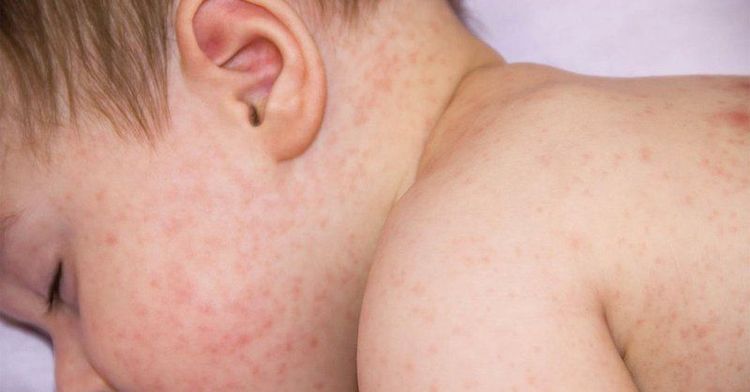 
Sốt mò gây ra biểu hiện lâm sàng là những nốt phát ban và viêm loét trên da
