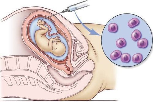 
Chọc ối giúp cung cấp các thông tin về sức khỏe và sự phát triển của thai nhi
