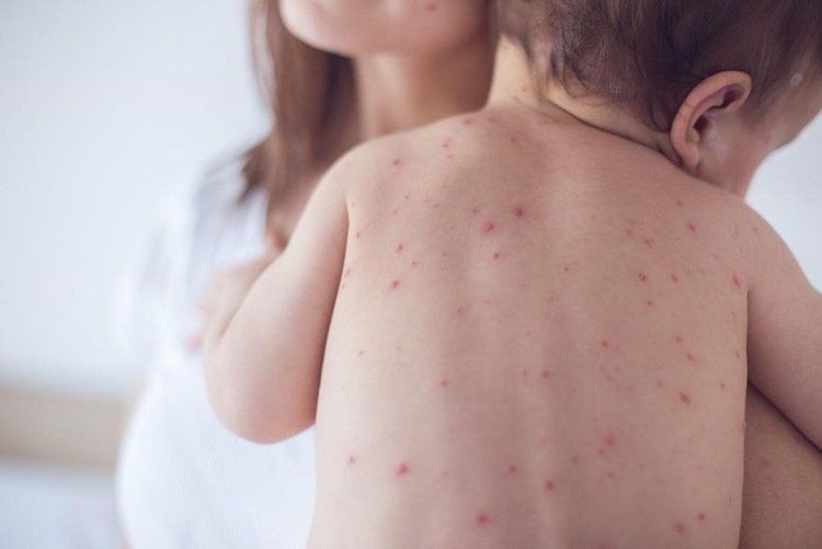 
Những nốt sần li ti trên da bé cũng có thể là biểu hiện của một số loại bệnh khác như phát ban, viêm da tiết bã,...
