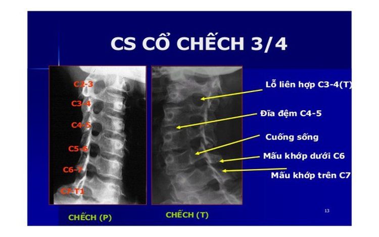 
X-quang cột sống cổ chếch 3/4 giúp thấy rõ nhất các đốt sống cổ và khe khớp
