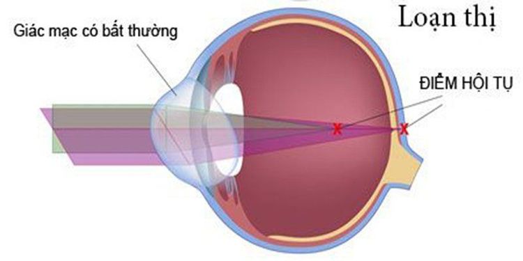 
Giác mạc méo mó khiến hình ảnh thu được bị biến dạng
