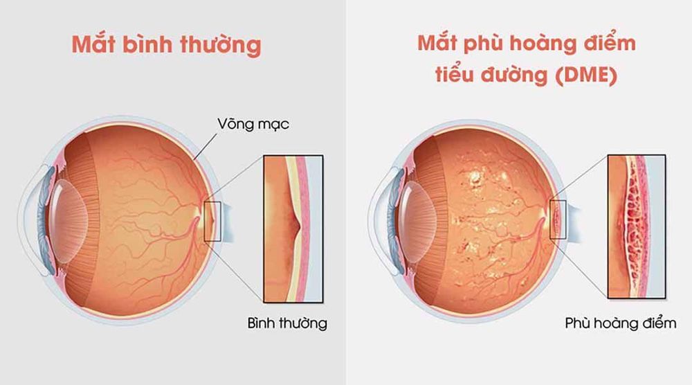 
Phù hoàng điểm trên bệnh nhân tiểu đường
