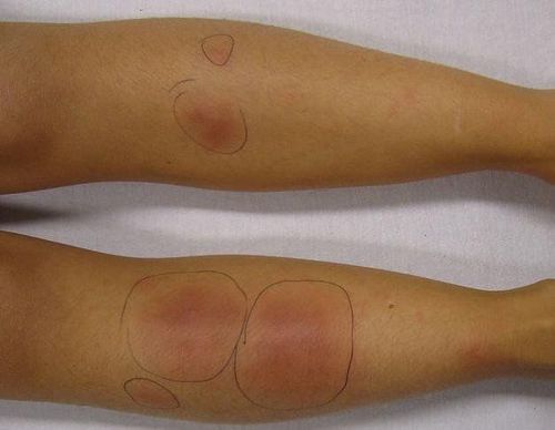 
Vùng da bị tổn thương có xu hướng dày lên

