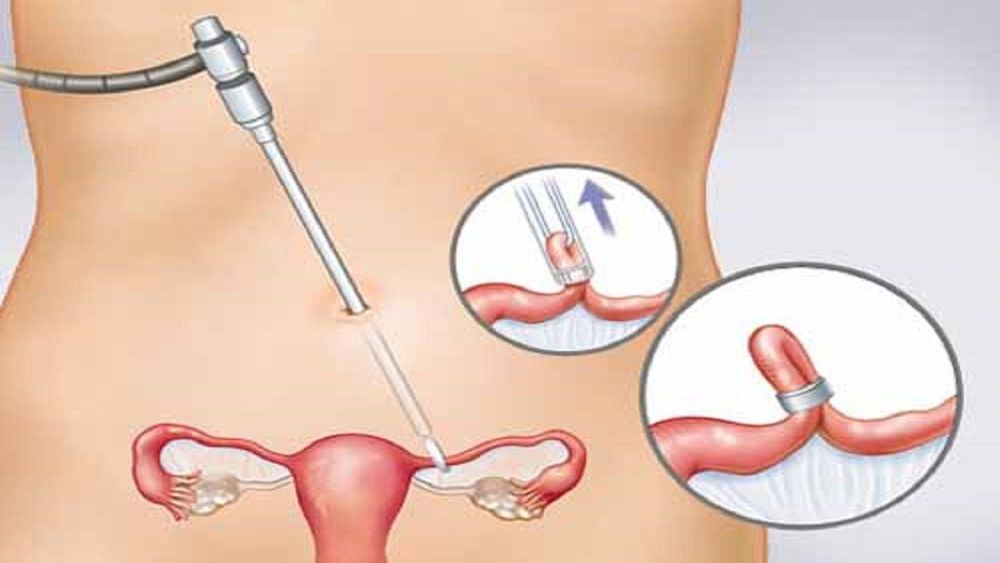 
Cắt buồng trứng khiến cho nồng độ estrogen mất cân bằng
