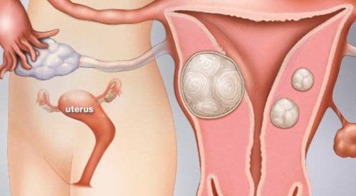 
Chụp X-quang buồng trứng cho phép chẩn đoán sớm bệnh u xơ tử cung
