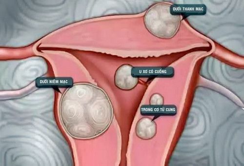 
Phụ nữ mắc nhân xơ tử cung cần thực hiện kỹ thuật siêu âm bơm nước buồng tử cung
