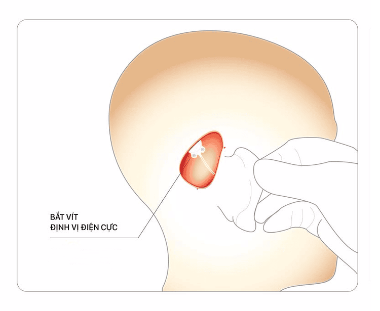 
Hình ảnh vị trí đặt điện cực ốc tai
