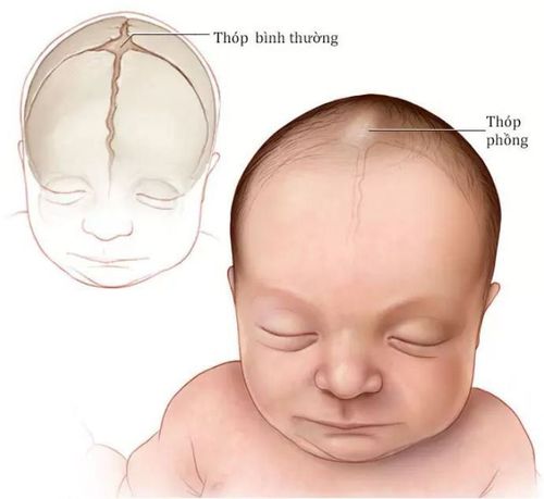 
Trẻ có hai thóp gồm thóp trước hình tứ giác được giới hạn bởi 2 xương đỉnh và 2 xương trán
