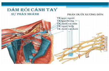 Các phương pháp gây tê đám rối thần kinh cánh tay