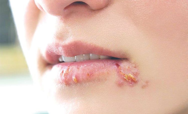 
Xét nghiệm giang mai RPR có thể dùng để xác định kháng thể xoắn khuẩn giang mai

