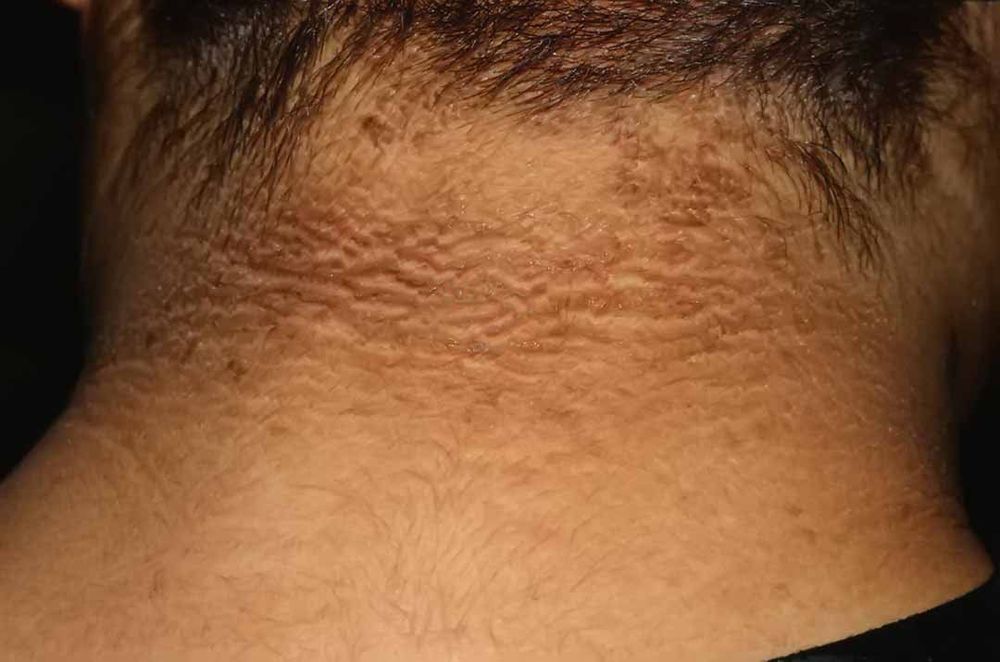 
Hình ảnh da của người bị tiểu đường mắc chứng gai đen

