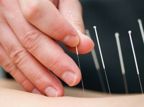 
Châm cứu chữa đau đầu cần được thực hiện bởi bác sĩ giàu kinh nghiệm
