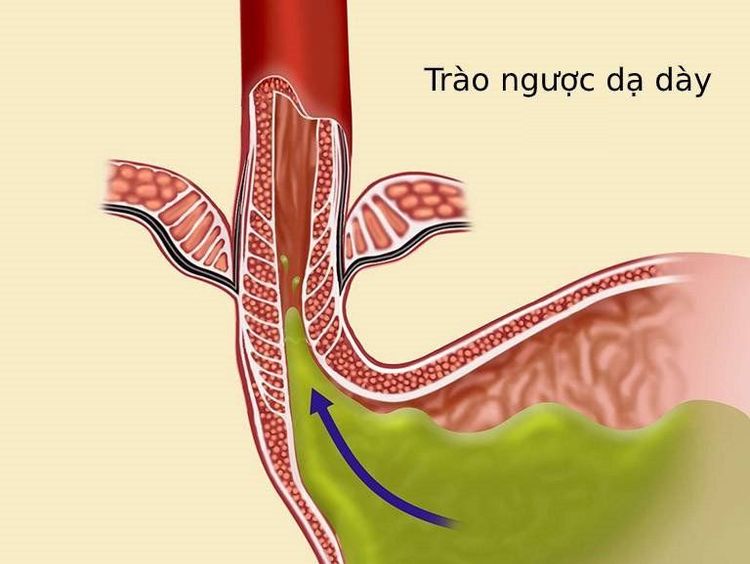 
Trào ngược dịch dạ dày vào đường thở là một tai biến thường gặp do đặt nội khí quản
