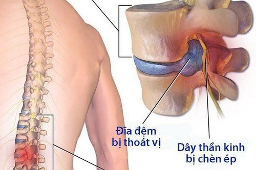 
Thoát vị đĩa đệm vùng thắt lưng là nguyên nhân gây đau thần kinh tọa ở người già
