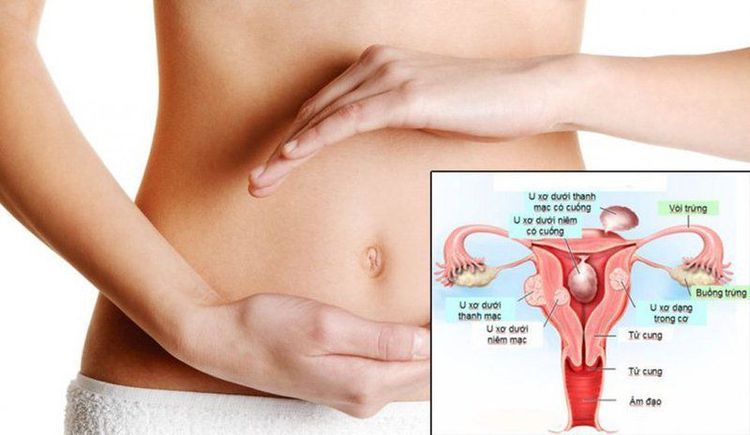 
Bệnh u xơ tử cung có thể gây vô sinh
