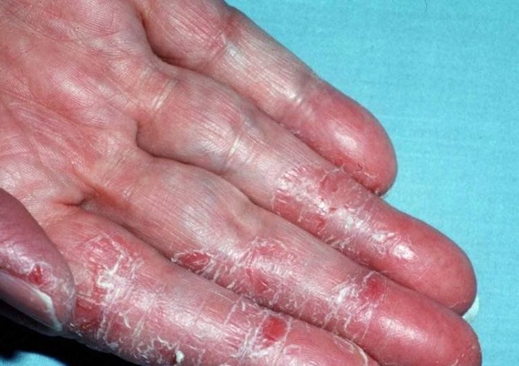 
Viêm da tiếp xúc kích ứng do chất tẩy rửa
