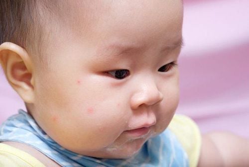 
Mụn sữa ở trẻ sơ sinh có thể tự động hết trong vòng từ vài tuần đến vài tháng
