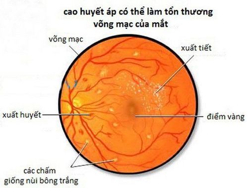 
Xuất huyết võng mạc do tăng huyết áp gây ra
