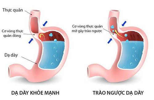 Gây mê nội khí quản có thể bị trào ngược dịch dạ dày