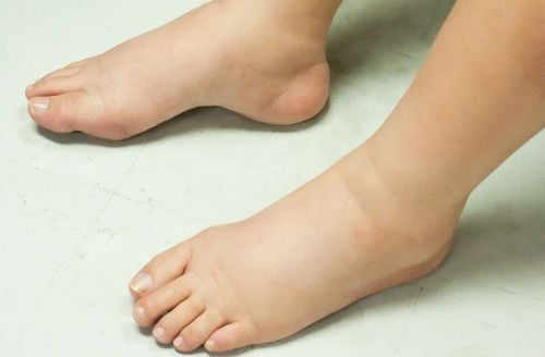 Triệu chứng thường thấy là phù trắng, mềm, ấn lõm.