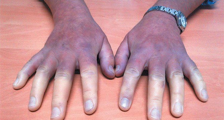 
Bệnh đa xơ cứng có thể gây liệt tứ chi
