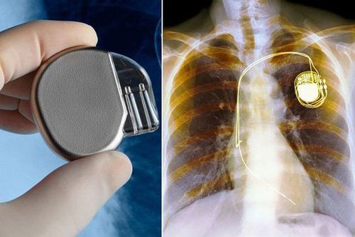 
Trước khi chụp MRI người bệnh cần tháo hết đồ kim loại trên cơ thể

