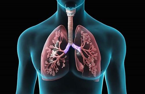 
Điều trị đông đặc phổi tức là cần điều trị nguyên nhân gây ra nó.
