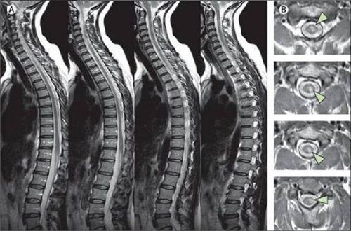 
MRI cột sống cũng phát hiện các nguyên nhân có thể khác gây đau lưng như gãy xương hay những thay đổi ở cột sống sau khi phẫu thuật
