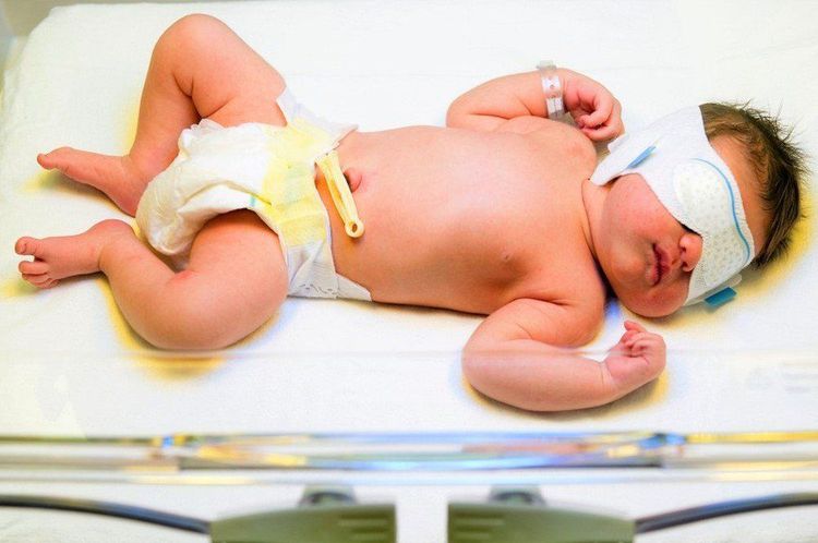 
Chiếu đèn vàng da không được áp dụng với những trẻ vàng da tăng Bilirubin trực tiếp
