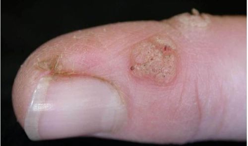 
Mụn cóc gây ra bởi nhiều loại vi-rút khác nhau
