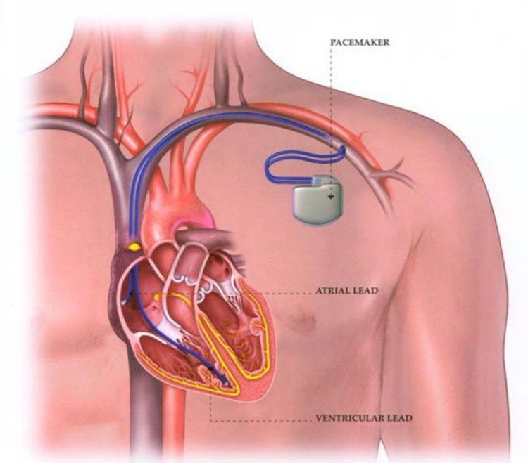 
Bệnh nhân có tiền sử cấy ghép máy tạo nhịp chống chỉ định tương đối thực hiện
