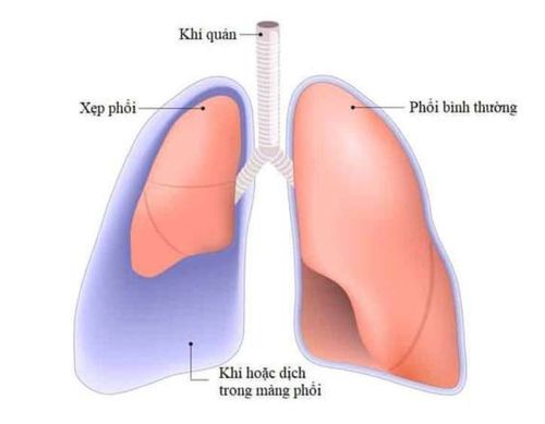 
Người bệnh có thể gặp tình trạng đau ngực do tràn dịch màng phổi
