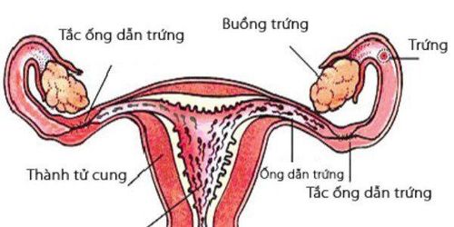 
Trường hợp tắc nghẽn ống dẫn trứng cần chụp X quang tử cung vòi trứng
