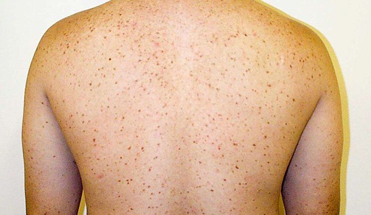 
Hội chứng bệnh tế bào mast ở da thường gặp ở trẻ em và đa số trẻ có biểu hiện mày đay sắc tố
