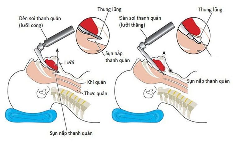 
Bệnh nhân được hướng dẫn nằm ngửa khi đặt nội khí quản bằng đường miệng
