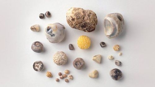 
Bệnh nhân có kích thước sỏi trên 20mm cũng được chỉ định mổ nội soi
