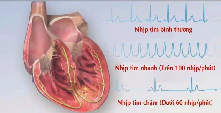 
Người bệnh có thể bị rối loạn nhịp tim sau khi thực hiện thủ thuật
