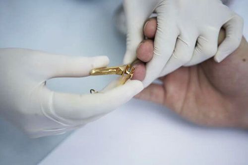 
Xét nghiệm móng tay tìm ký sinh trùng
