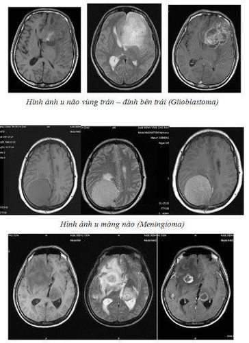 
Hình ảnh chụp MRI tưới máu não phản ánh tình trạng bệnh nhân
