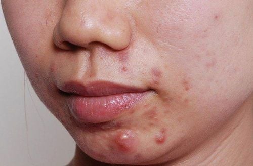 
Mụn mủ thường gây sưng tấy mất thẩm mỹ
