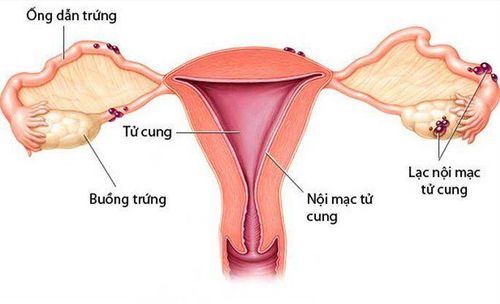 
Hình ảnh lạc nội mạc tử cung
