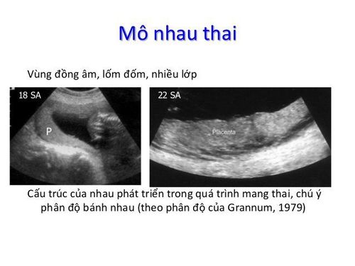 
Siêu âm bánh nhau cho thấy phần mô nhau thai
